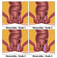 C'est un schéma, on peut voir les 4 stades d'évolution des hémorroïdes