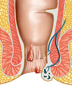 C'est un schéma qui zoom qur l'anatomie du canal anal et qui montre où sont situés les hémorroïdes 