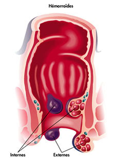 C'est un schéma qui montre où se situent les hémorroïdes internes et externes